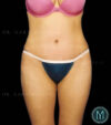 Tummy Tuck case #13519