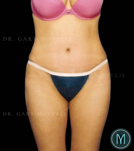 Tummy Tuck case #13519