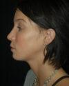 Profile Balancing case #12722