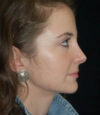 Revision Rhinoplasty case #13409
