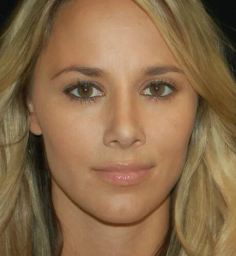 Rhinoplasty case #12768