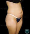 Tummy Tuck case #13519