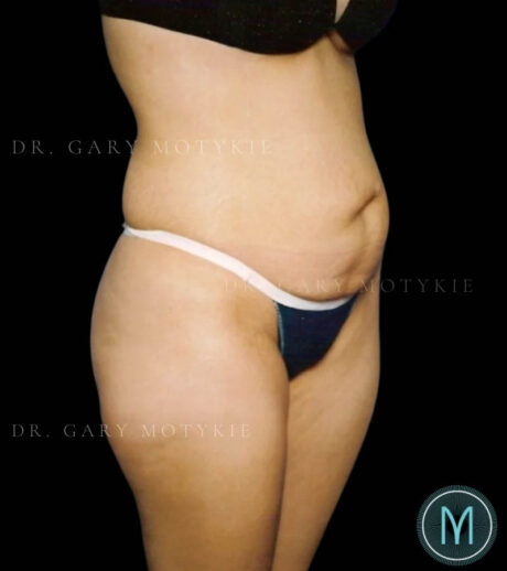 Tummy Tuck case #13519