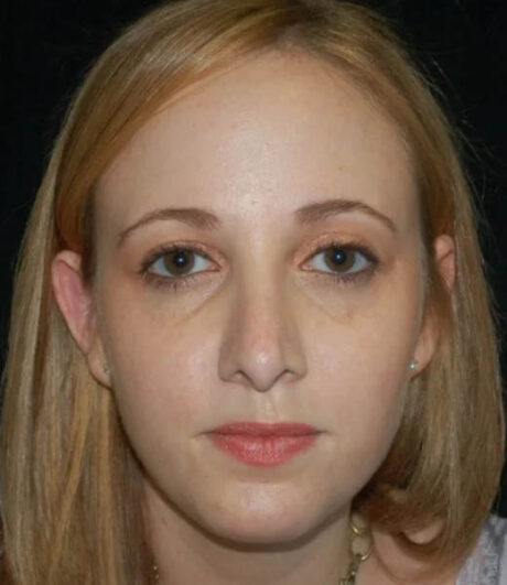 Revision Rhinoplasty case #13416