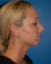 Profile Balancing case #12727