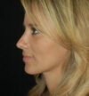 Rhinoplasty case #12768