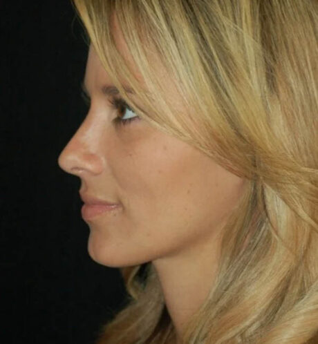 Rhinoplasty case #12768
