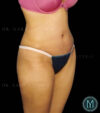 Tummy Tuck case #13519