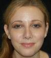 Revision Rhinoplasty case #13416