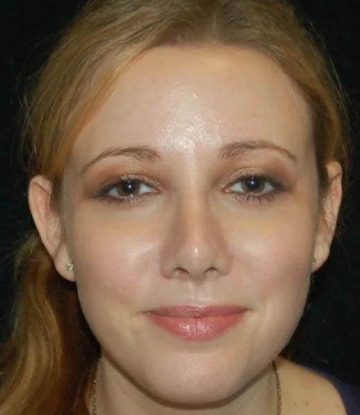 Revision Rhinoplasty case #13416