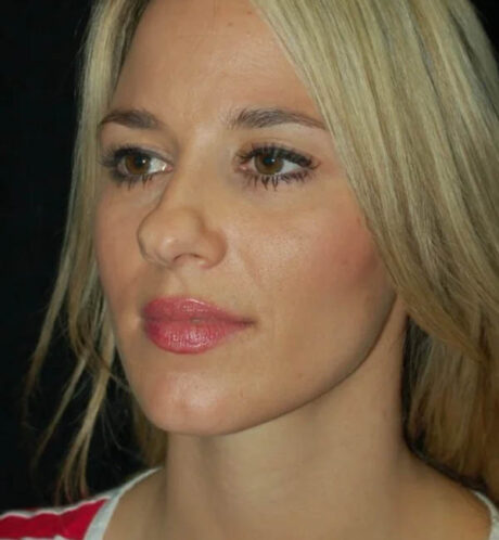 Rhinoplasty case #12768