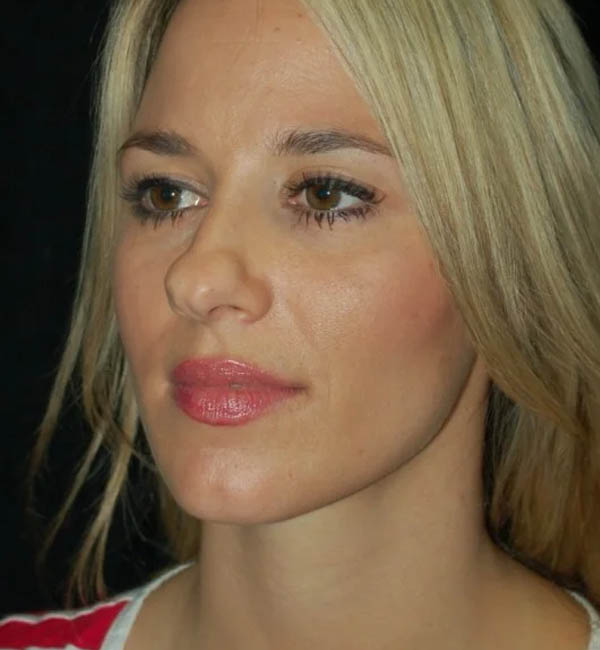 Rhinoplasty case #12768