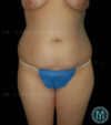 Tummy Tuck case #13526