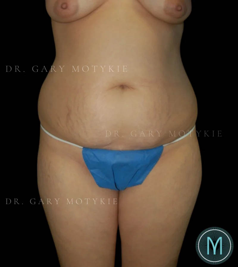 Tummy Tuck case #13526