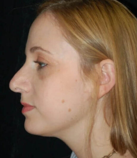 Revision Rhinoplasty case #13416
