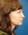 Profile Balancing case #12730