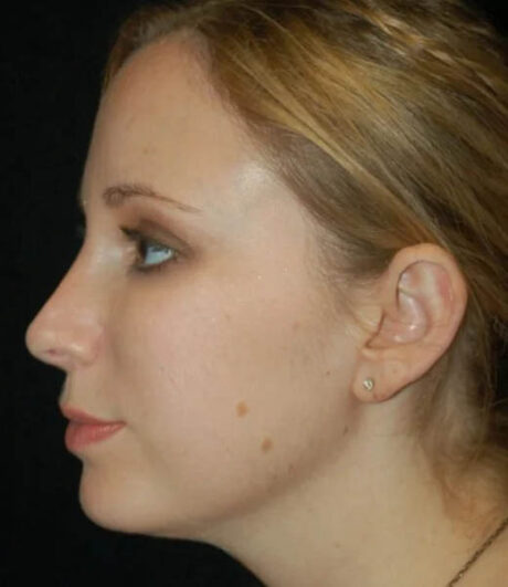 Revision Rhinoplasty case #13416