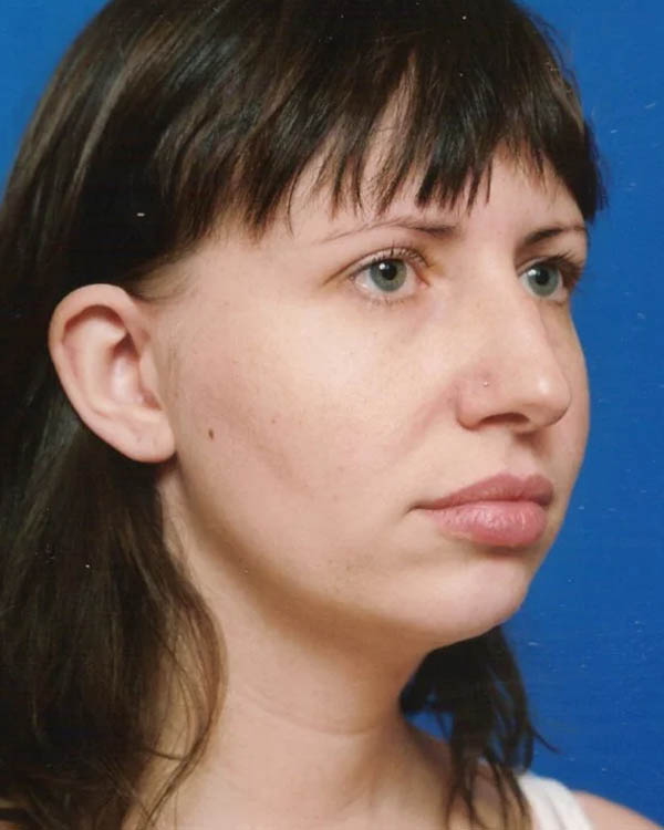 _0026_case-10-3-profile-balancing-chin-rhinoplasty-view-2-1.webp