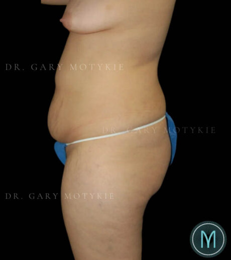 Tummy Tuck case #13526