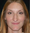Rhinoplasty case #12775