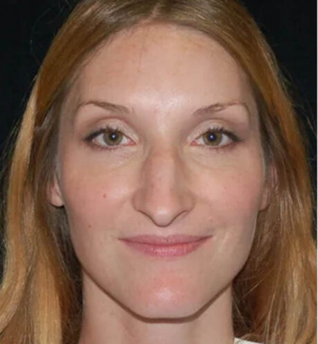 Rhinoplasty case #12775