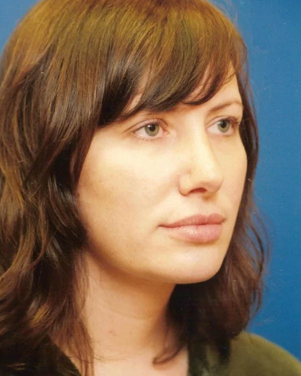 _0027_case-10-3-profile-balancing-chin-rhinoplasty-view-2-2.webp
