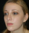 Revision Rhinoplasty case #13416
