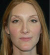 Rhinoplasty case #12775