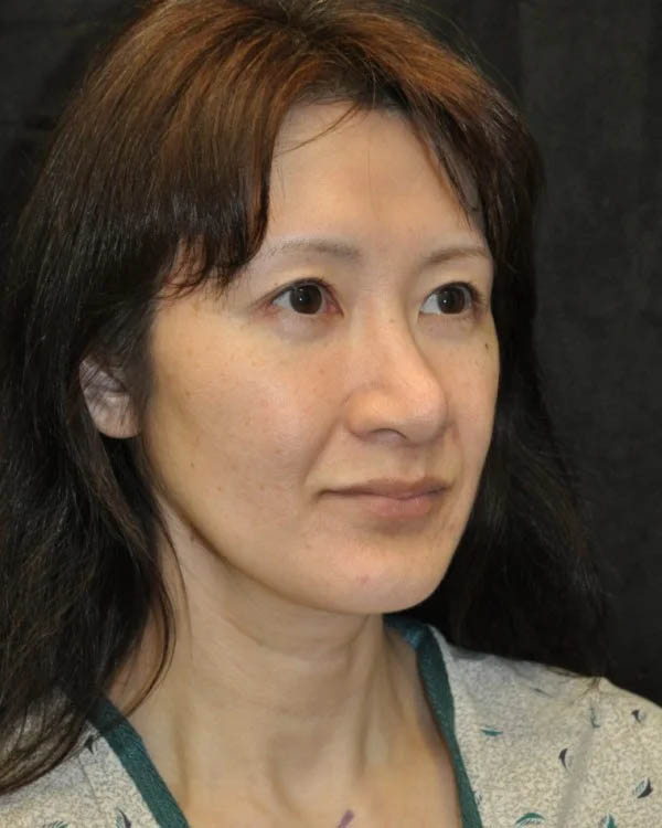 _0028_case-11-10-profile-balancing-chin-rhinoplasty-view-1-1.webp