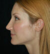 Rhinoplasty case #12775