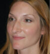 Rhinoplasty case #12775