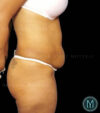 Tummy Tuck case #13533