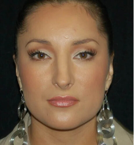 Rhinoplasty case #12782