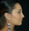 Rhinoplasty case #12782
