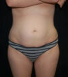 Tummy Tuck case #13534