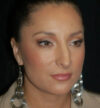 Rhinoplasty case #12782