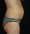 Tummy Tuck case #13534