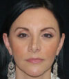 Revision Rhinoplasty case #13426