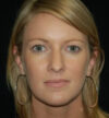 Rhinoplasty case #12789