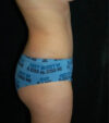 Tummy Tuck case #13534