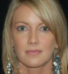 Rhinoplasty case #12789