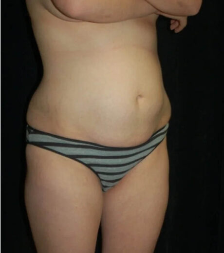 Tummy Tuck case #13534