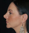 Revision Rhinoplasty case #13426