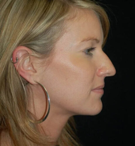 Rhinoplasty case #12789