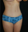 Tummy Tuck case #13534