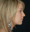 Rhinoplasty case #12789