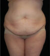 Tummy Tuck case #13547