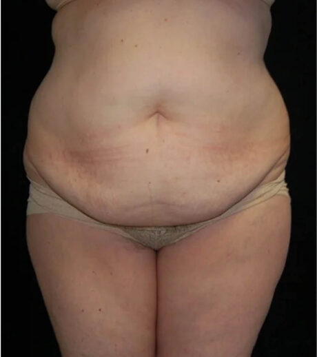 Tummy Tuck case #13547