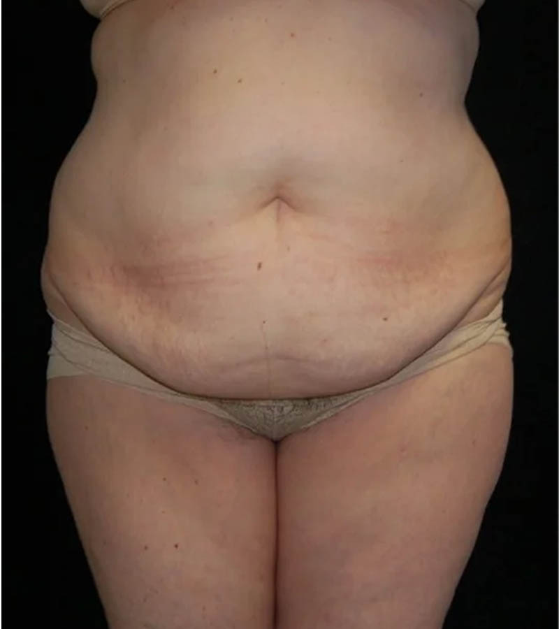 Tummy Tuck case #13547