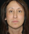 Revision Rhinoplasty case #13433
